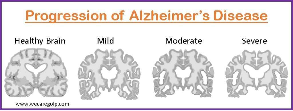 Progression of Alzheimer's Disease