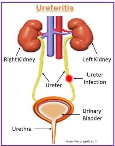 Ureteritis