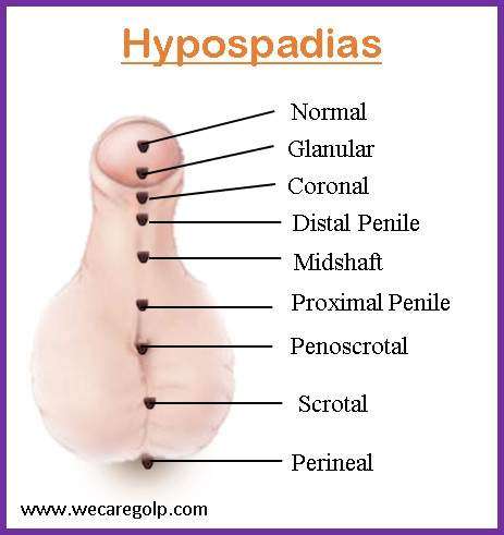 Hypospadias