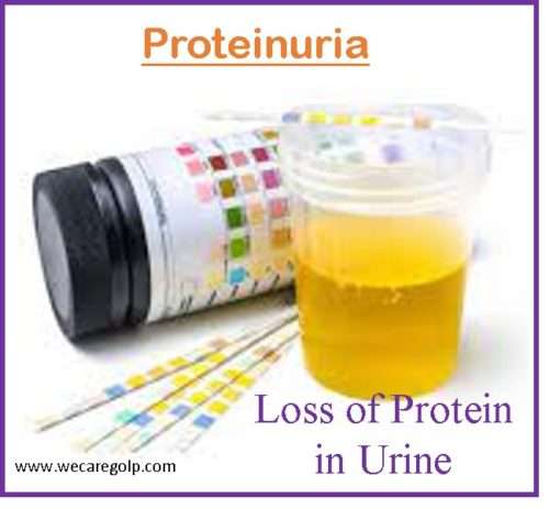 Proteinuria Protein In Urine We Care 9573