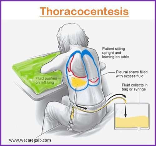 Thoracocentesis