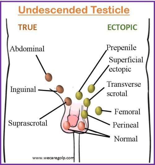 Undescended Testicle