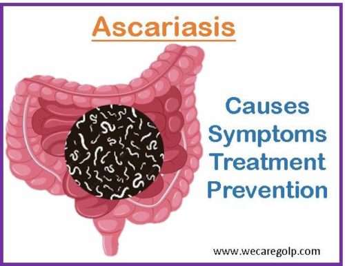 Ascariasis: Causes, Treatment, Prevention - We Care