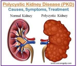 Polycystic Kidney Disease (PKD) - We Care